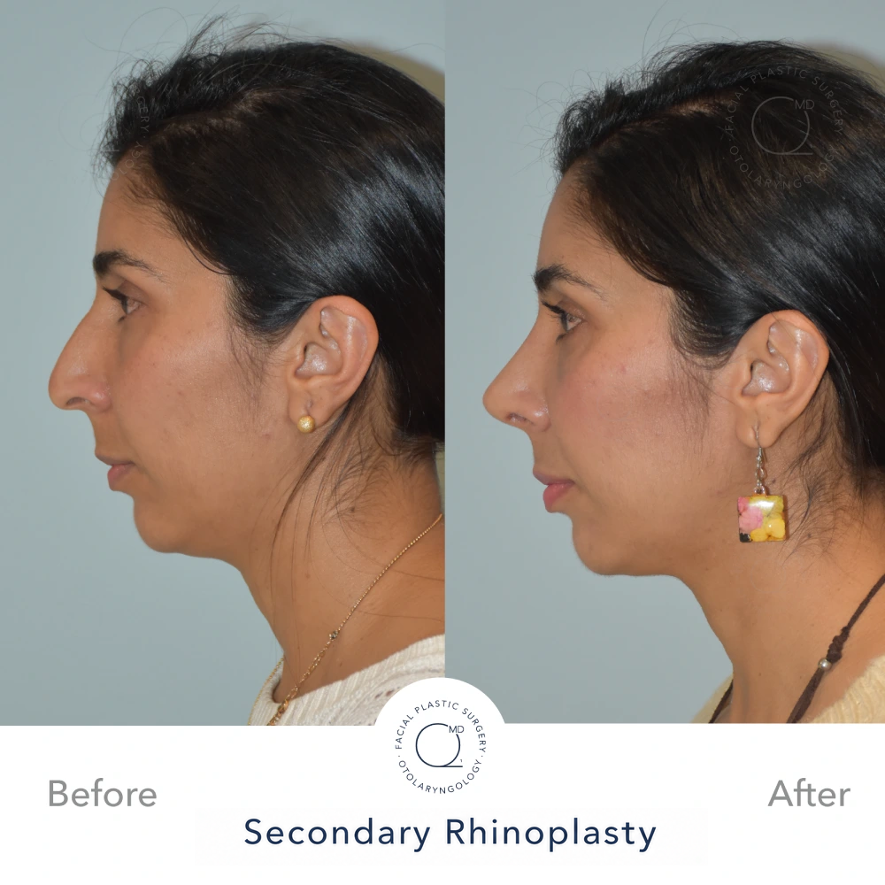 Resultado documentado a 24 meses tras septorrinoplastia reconstructiva funcional por abordaje cerrado, perfil izquierdo