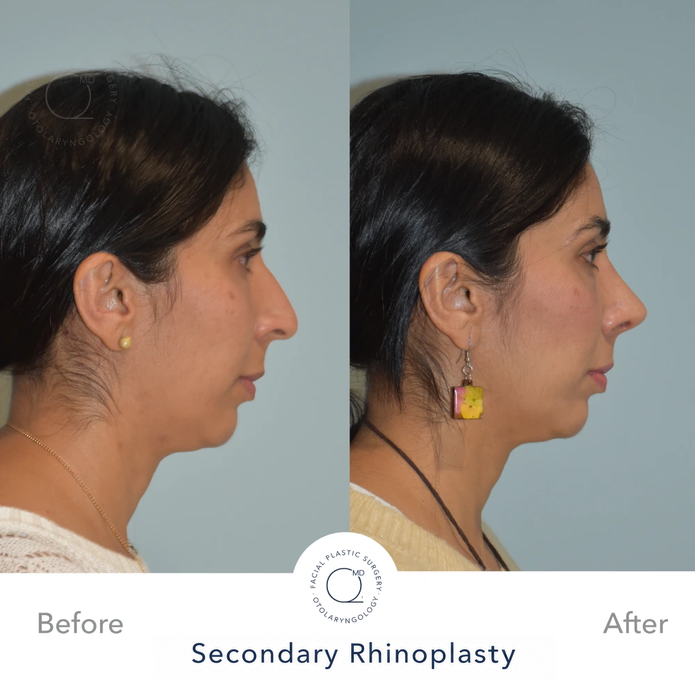 Comparativa preoperatoria y postoperatoria, perfil derecho, resultado a 24 meses tras septorrinoplastia reconstructiva funcional cerrada