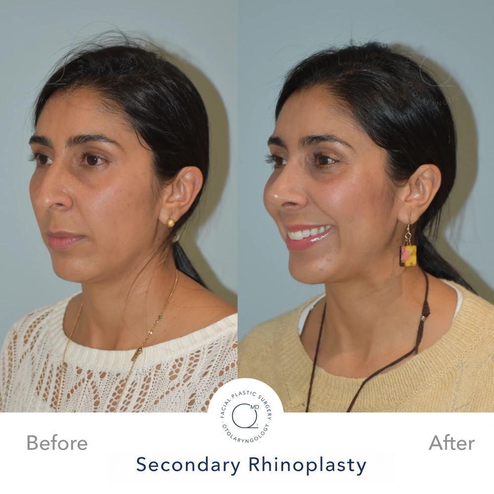 Comparativa preoperatoria y postoperatoria, vista oblicua izquierda, resultado a 24 meses tras septorrinoplastia reconstructiva funcional cerrada