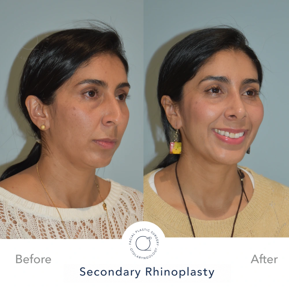Comparativa preoperatoria y postoperatoria, vista oblicua derecha, resultado a 24 meses tras septorrinoplastia reconstructiva funcional cerrada