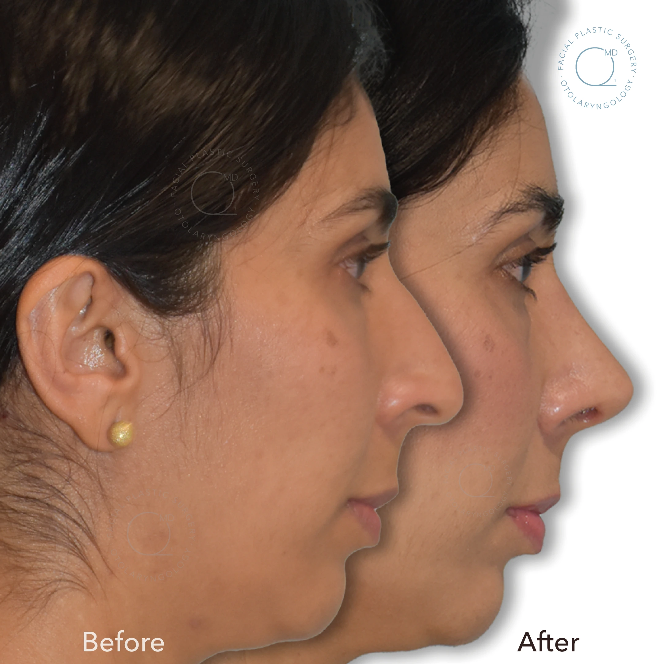 Comparativa antes y después de rinoplastia secundaria funcional, vista de perfil