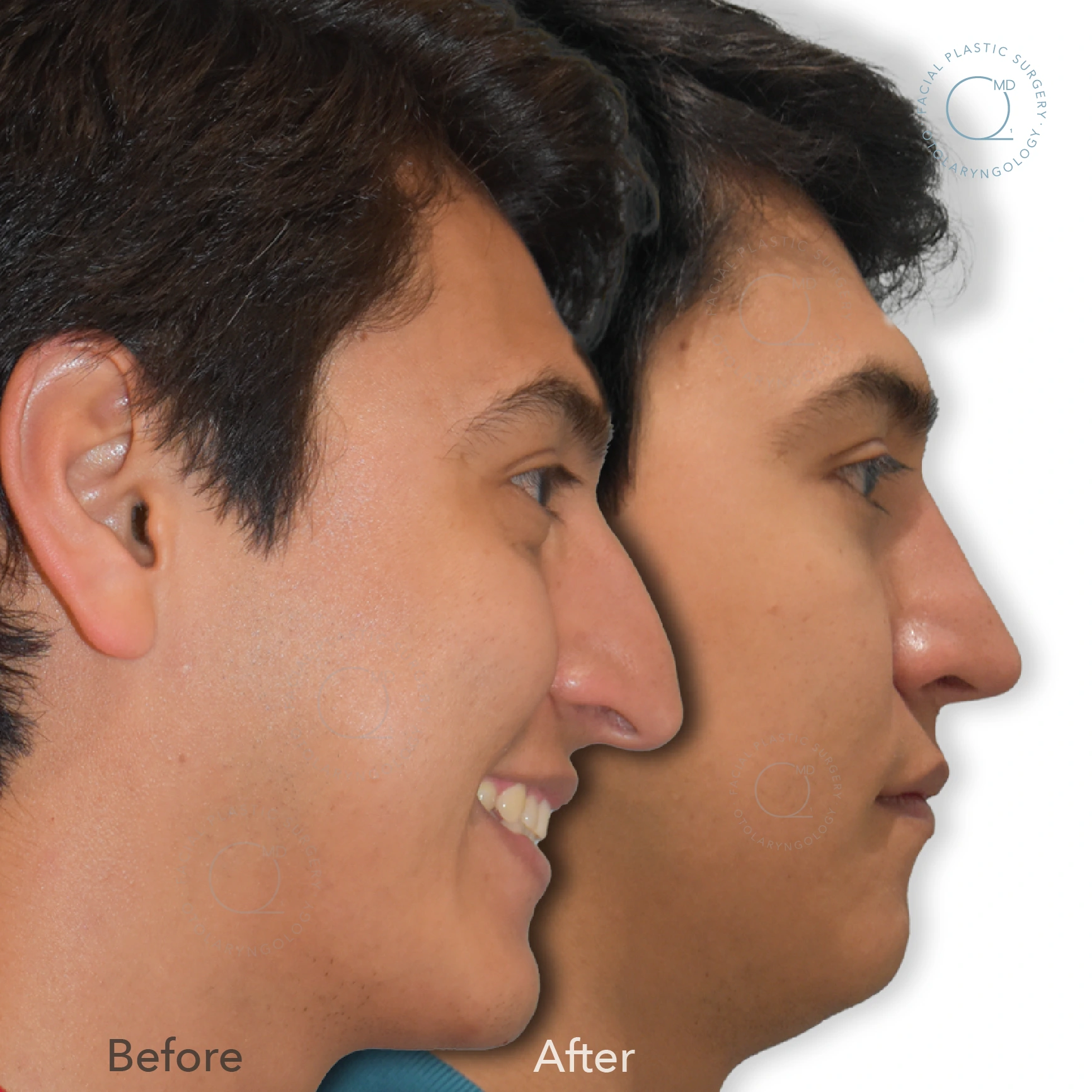 Foto rinoplastia madrid caso 22
