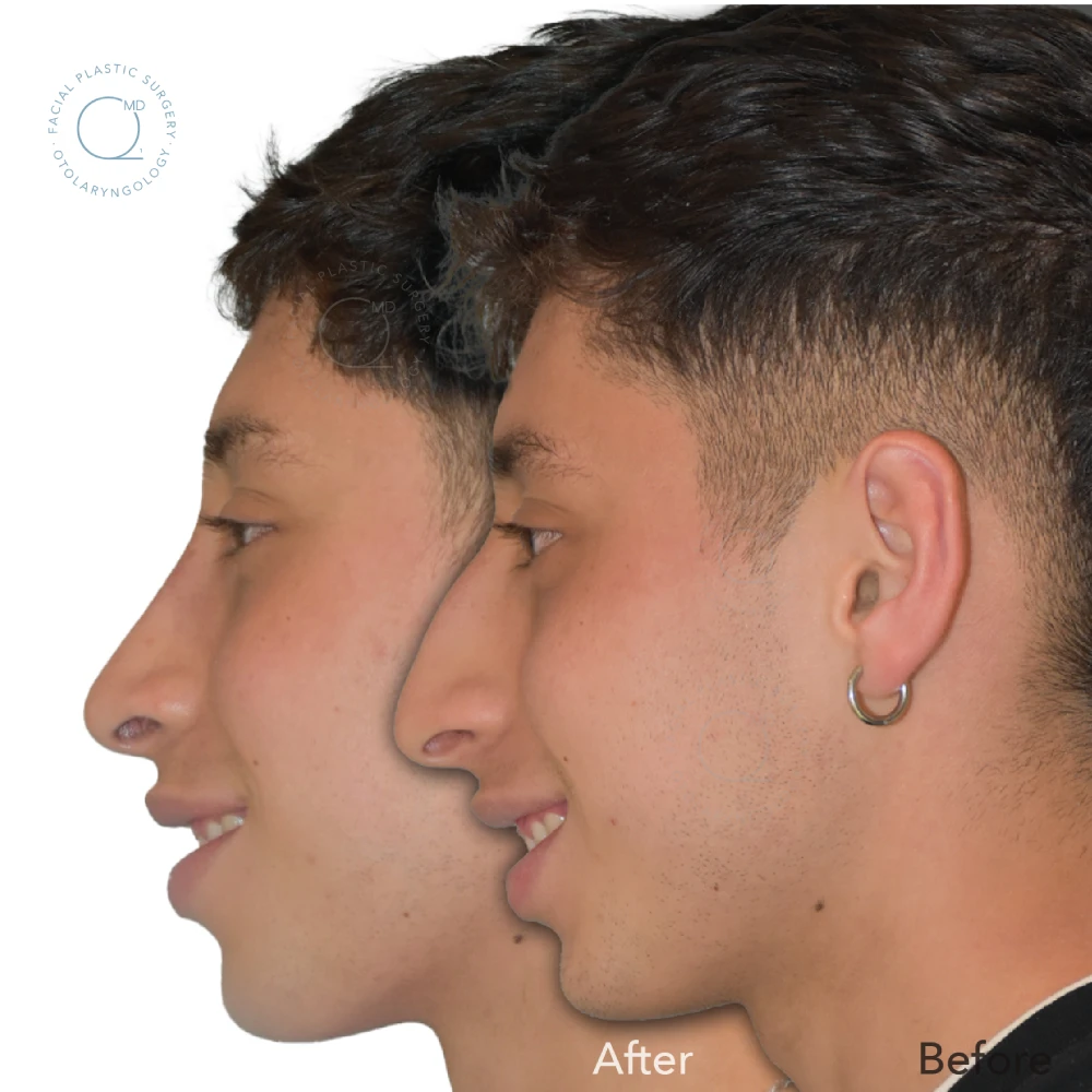 foto-rinoplastia-madrid-caso-35