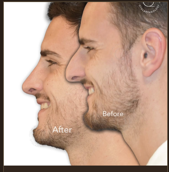 Rinoplastia masculina antes y después