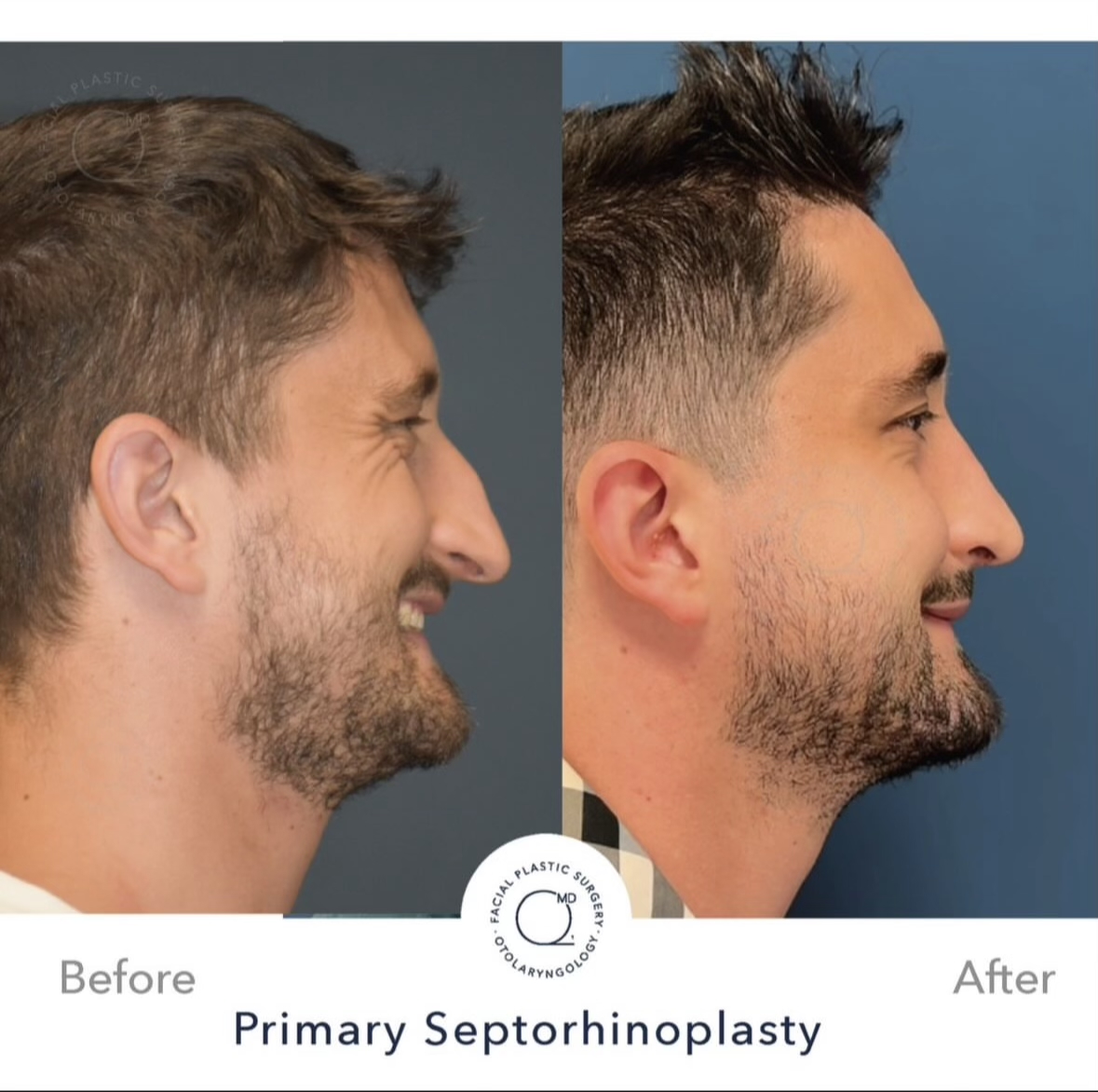 Rinoplastia masculina — fotografía interna lateral
