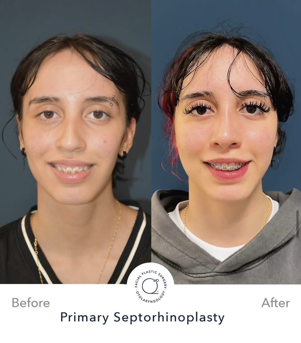 Rinoplastia femenina — fotografía interna frontal sonriente