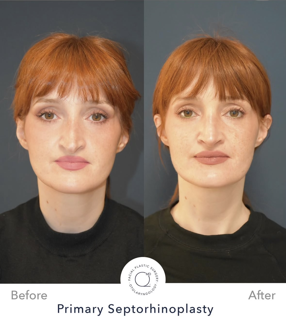 Rinoplastia femenina — fotografía interna frontal