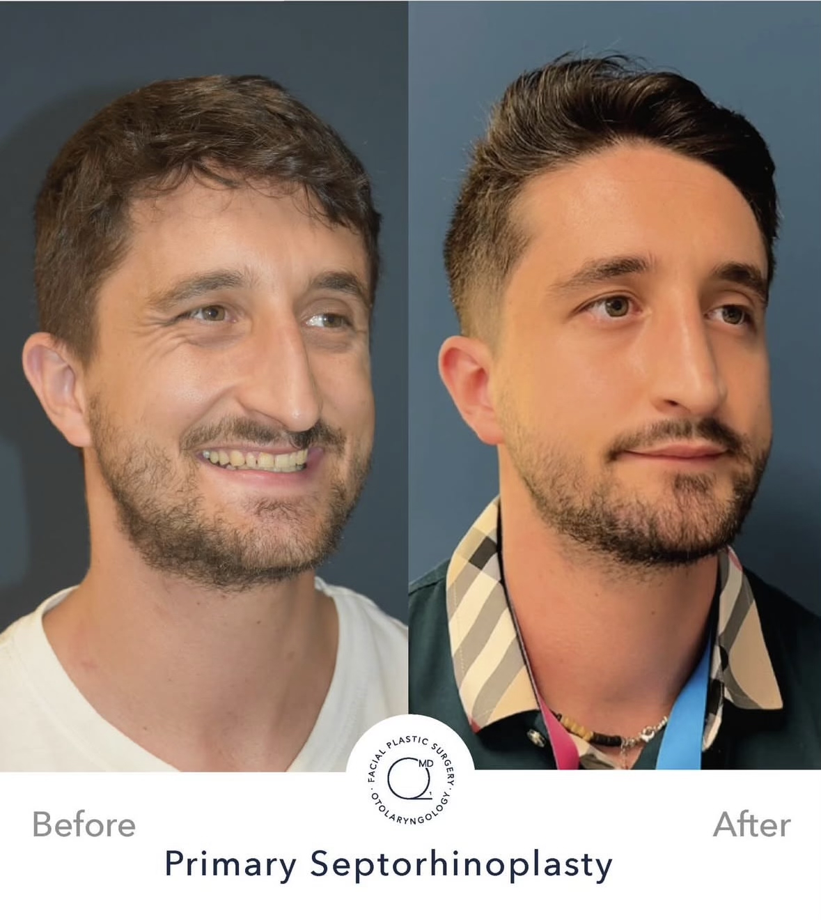 Rinoplastia masculina — fotografía interna frontal oblicua