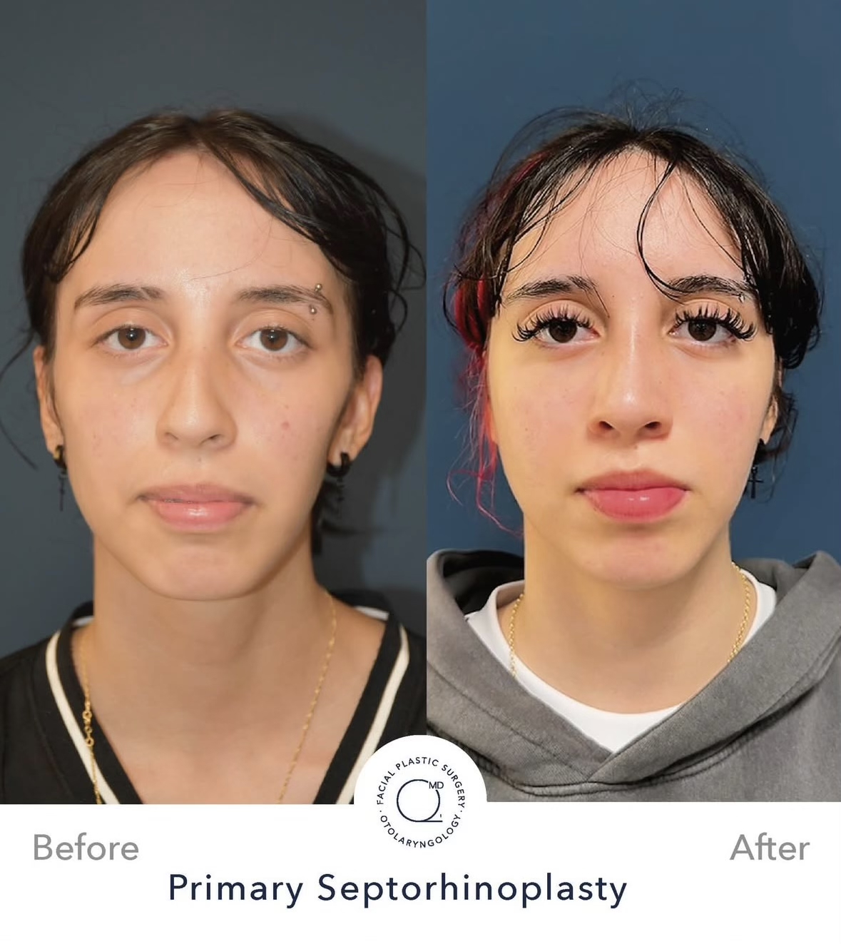 Rinoplastia femenina — fotografía interna frontal