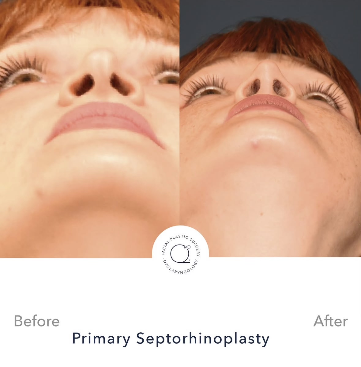 Rinoplastia femenina — fotografía interna inferior