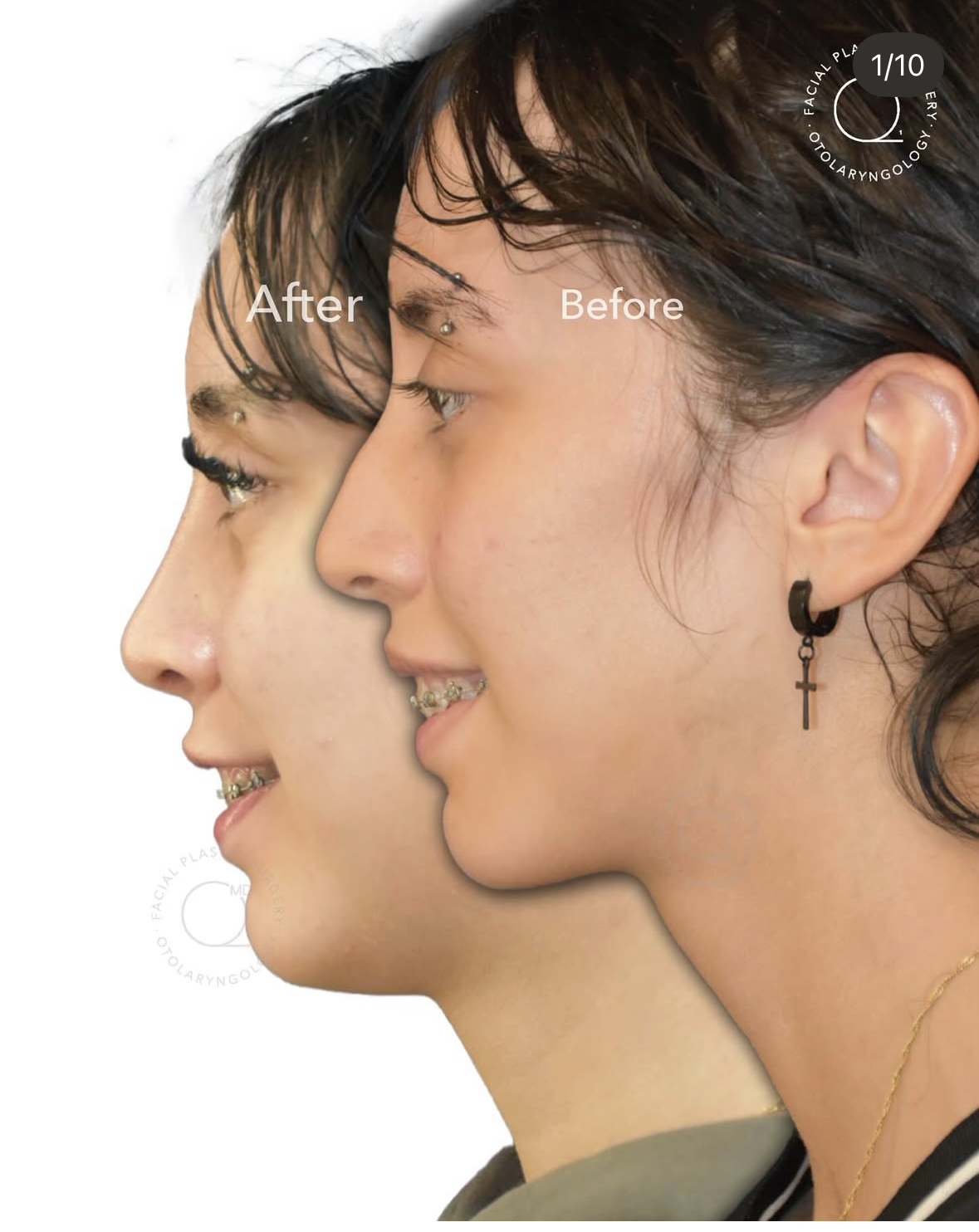 Rinoplastia femenina antes y después