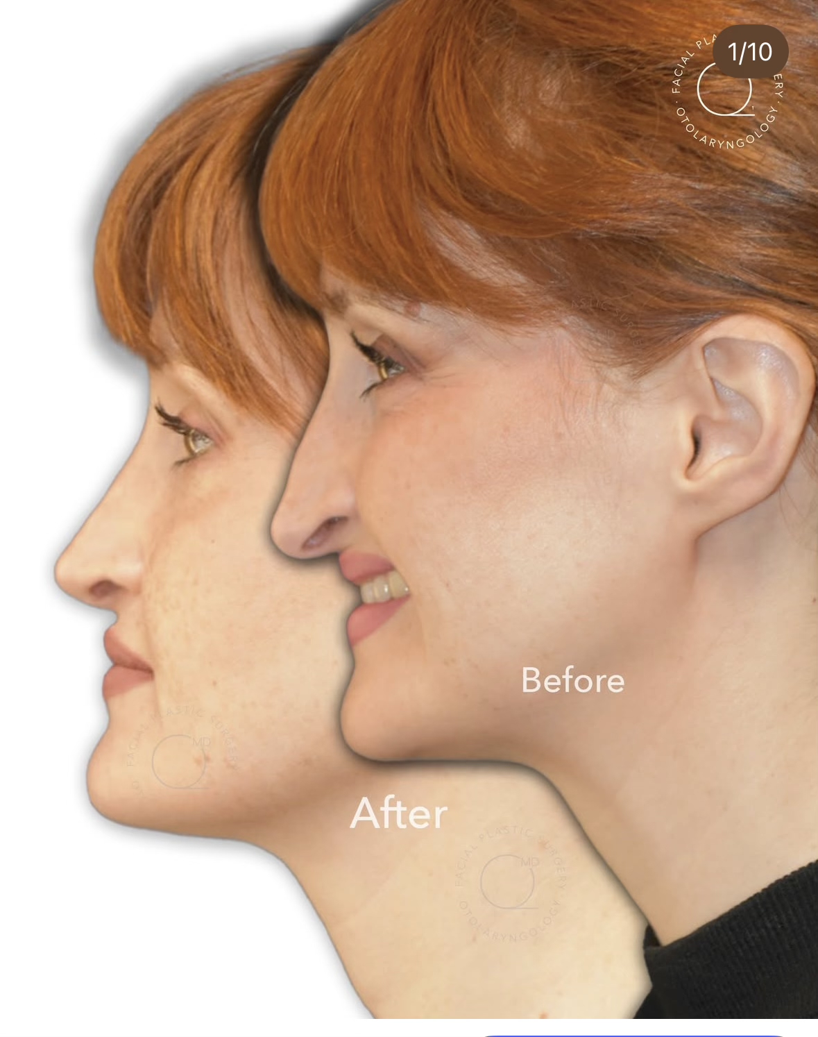 Rinoplastia femenina antes y después