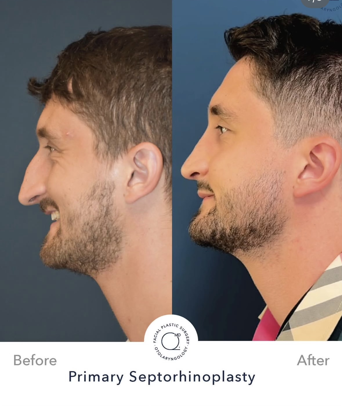 Rinoplastia masculina — fotografía interna lateral elevada