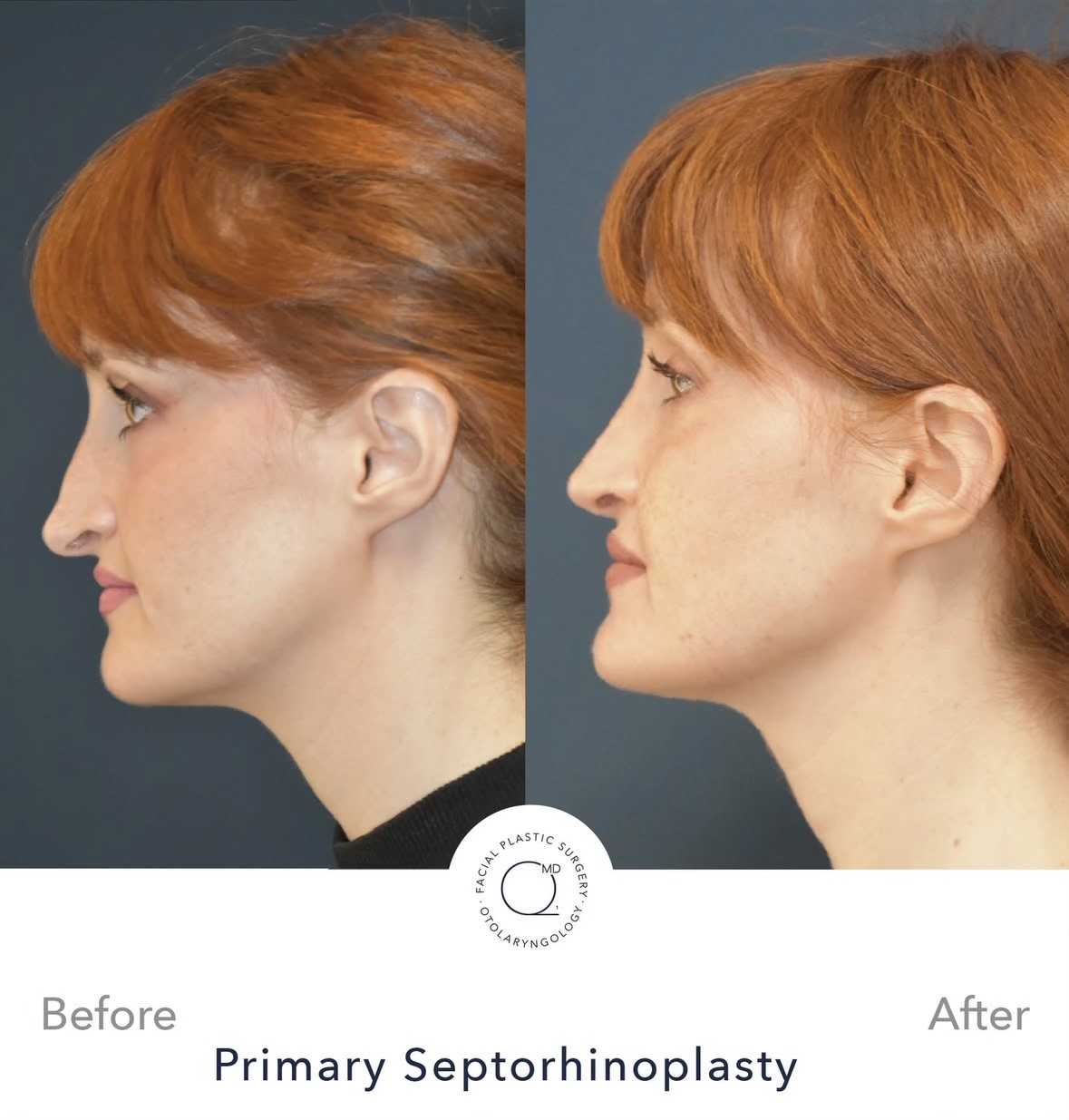 Rinoplastia femenina — fotografía interna oblicua