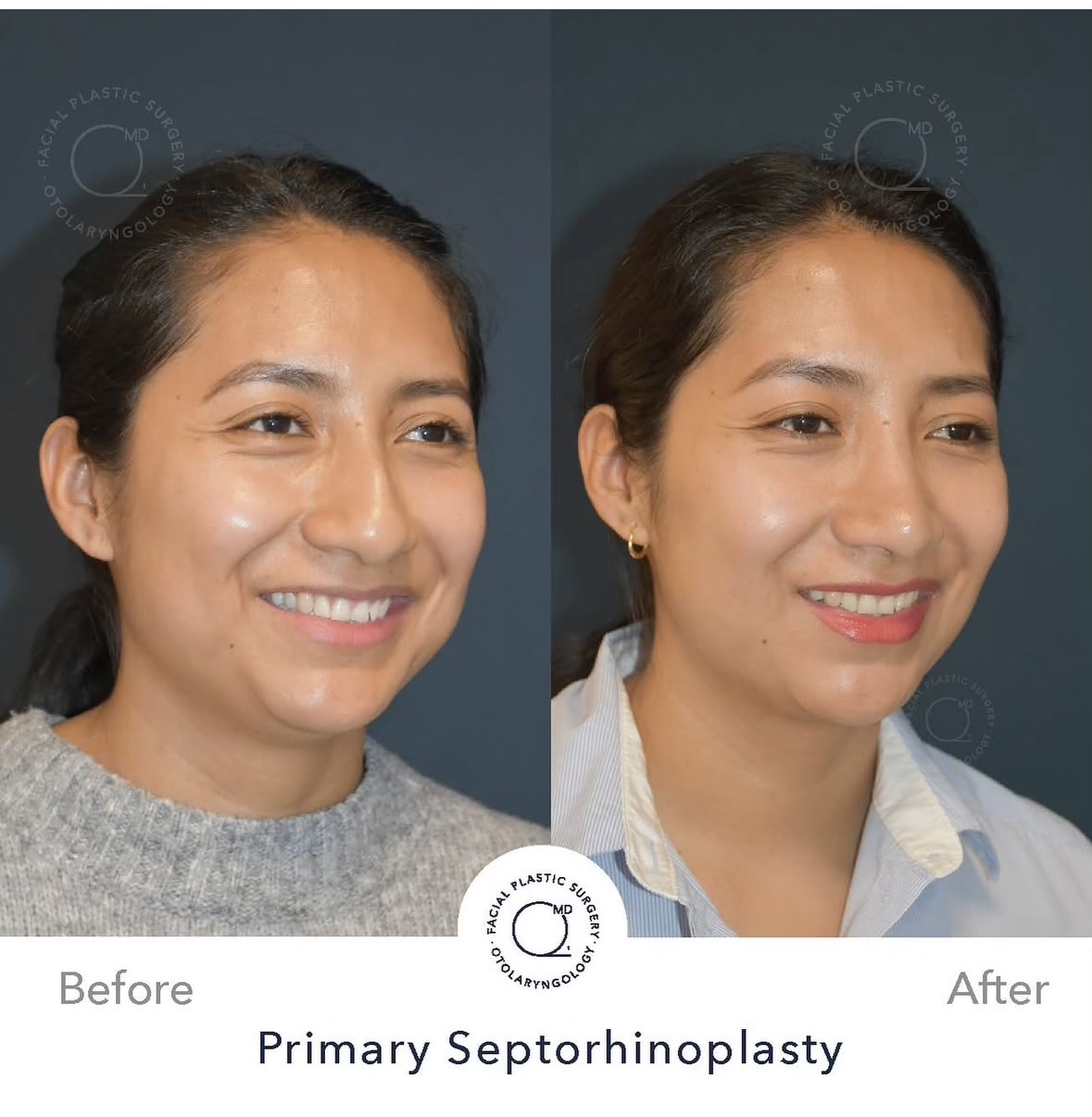 Rinoplastia femenina — fotografía interna oblicua sonriente