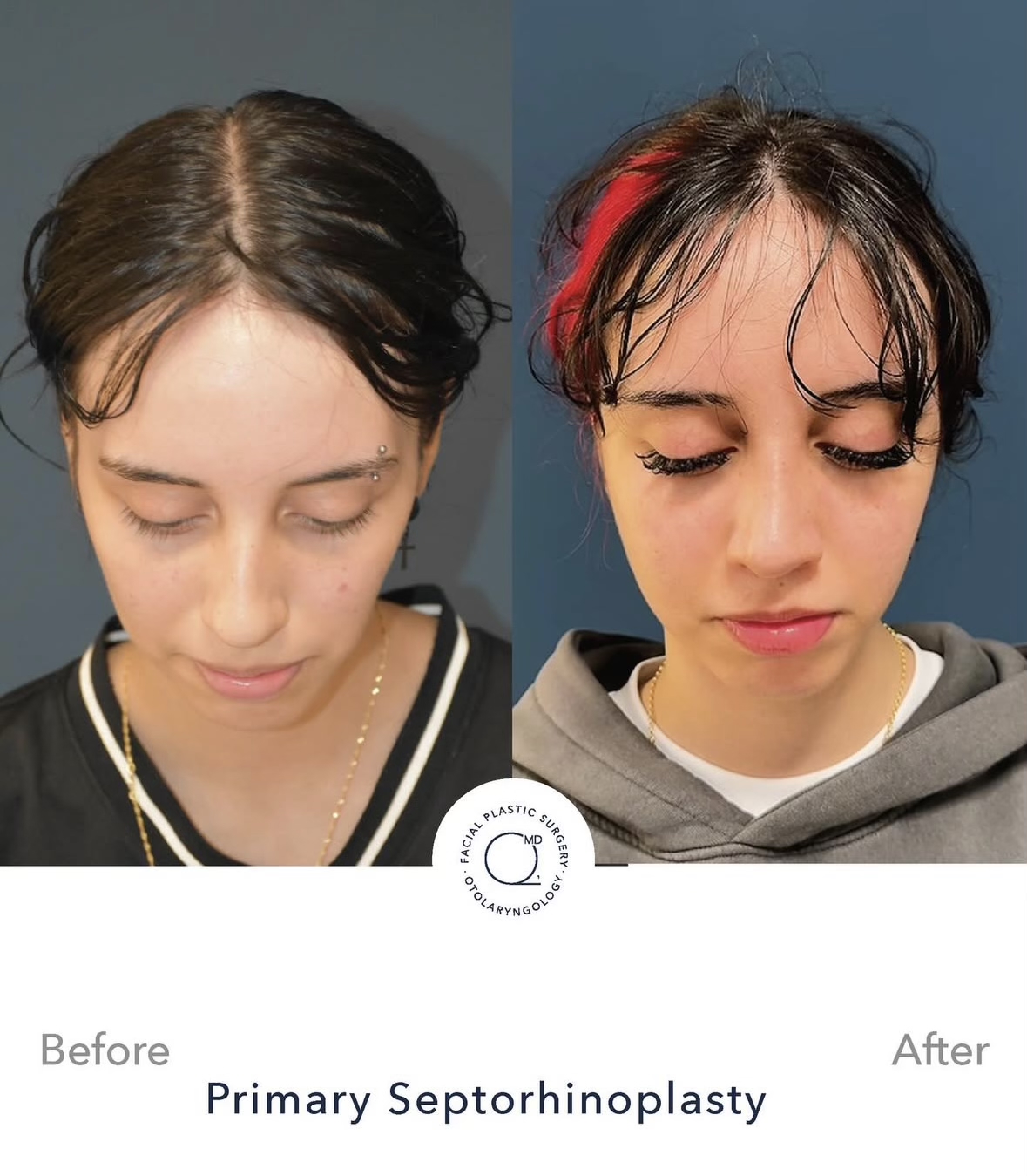 Rinoplastia femenina — fotografía interna superior