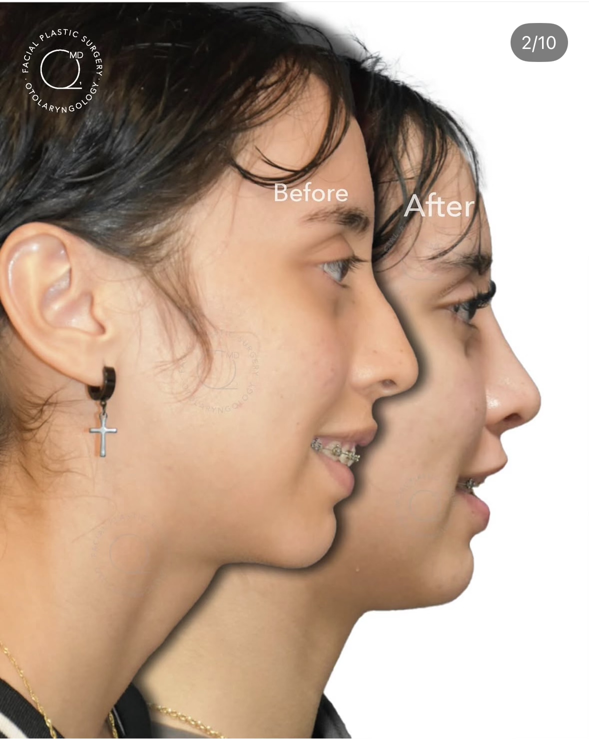 Rinoplastia femenina — fotografía interna lateral