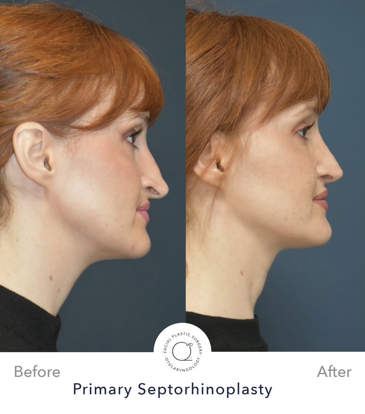 Rinoplastia femenina — fotografía interna lateral opuesta