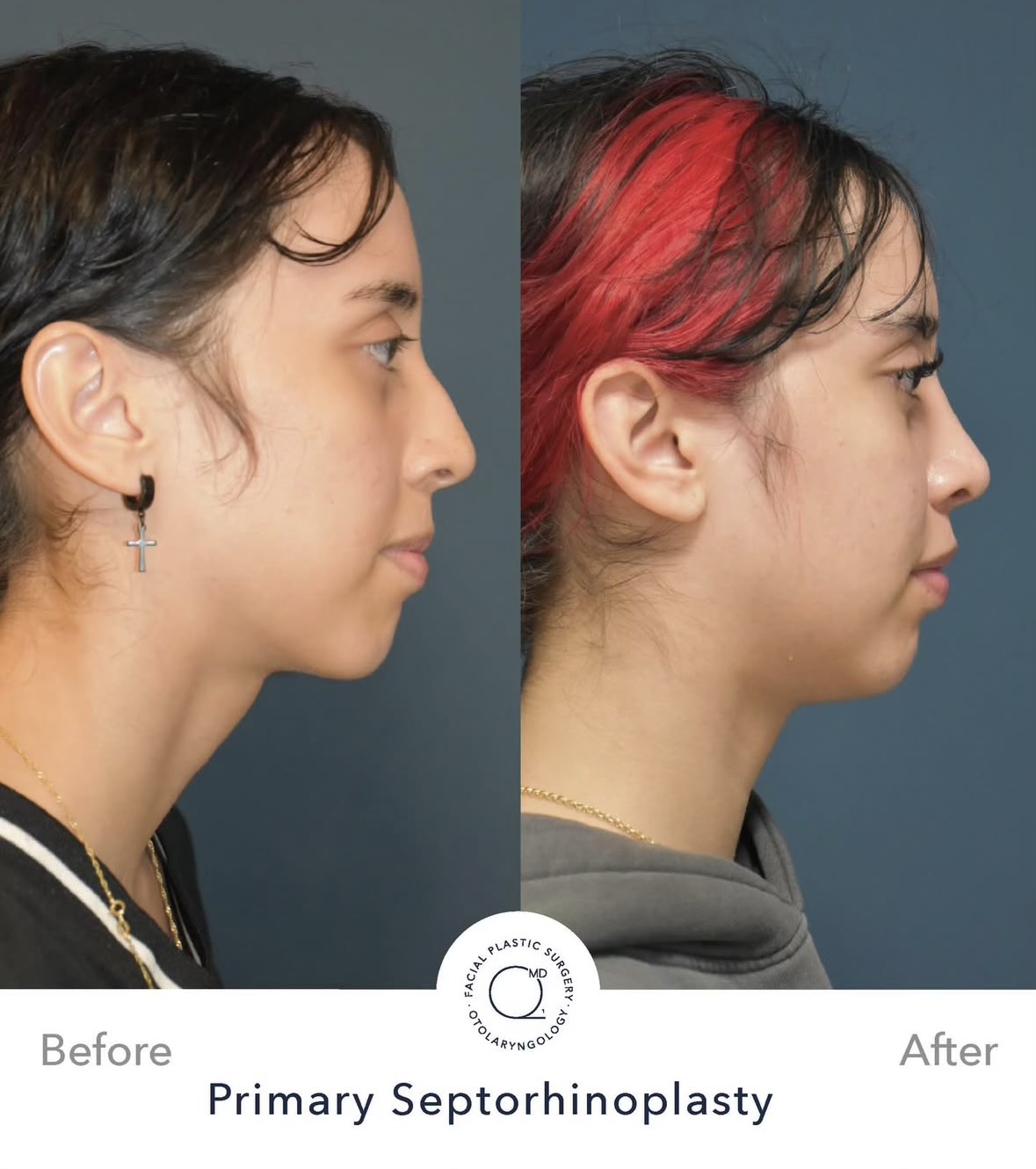 Rinoplastia femenina — fotografía interna lateral