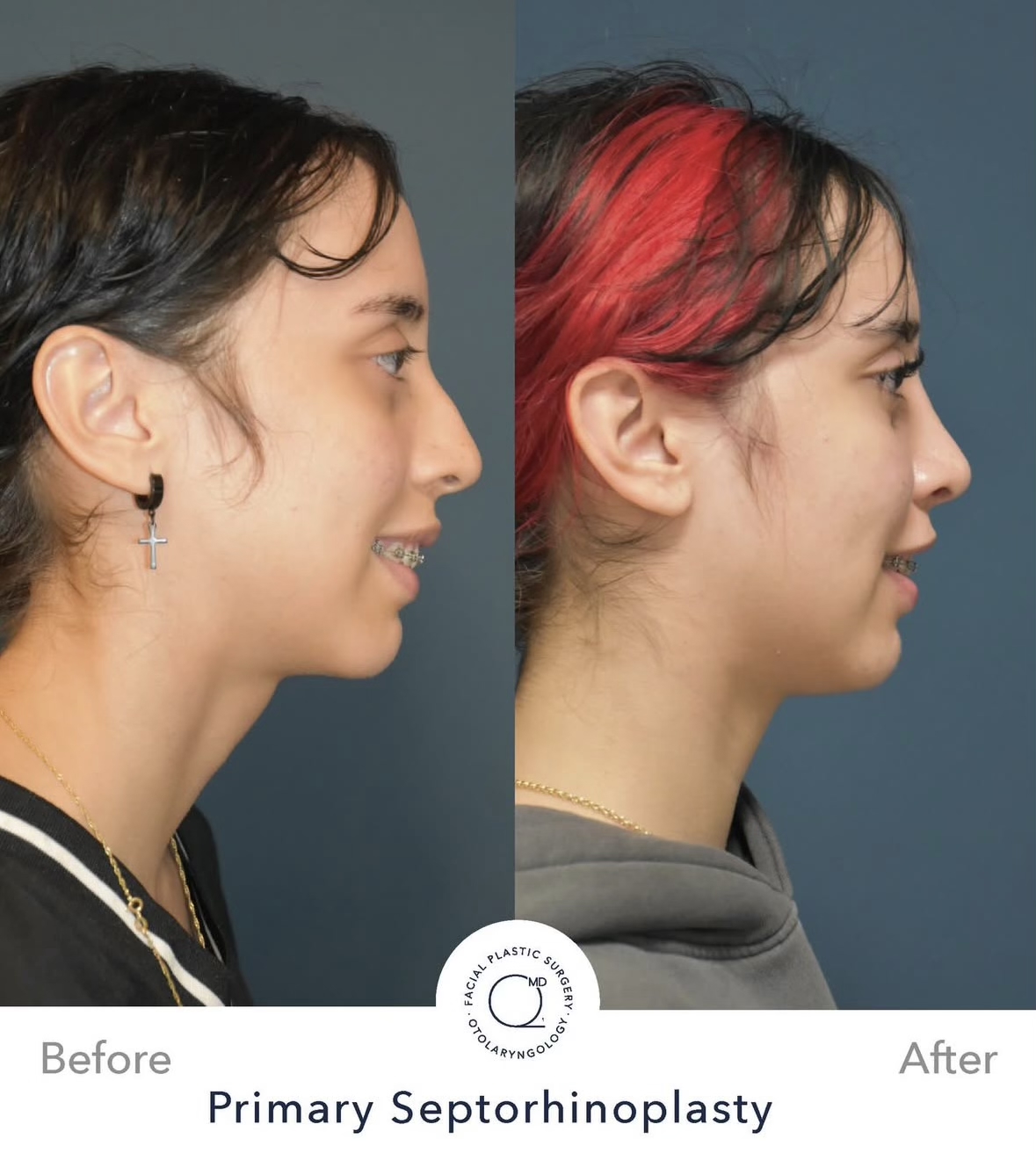 Rinoplastia femenina — fotografía interna lateral