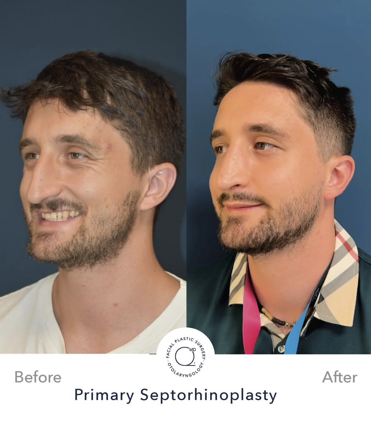Rinoplastia masculina — fotografía interna oblicua