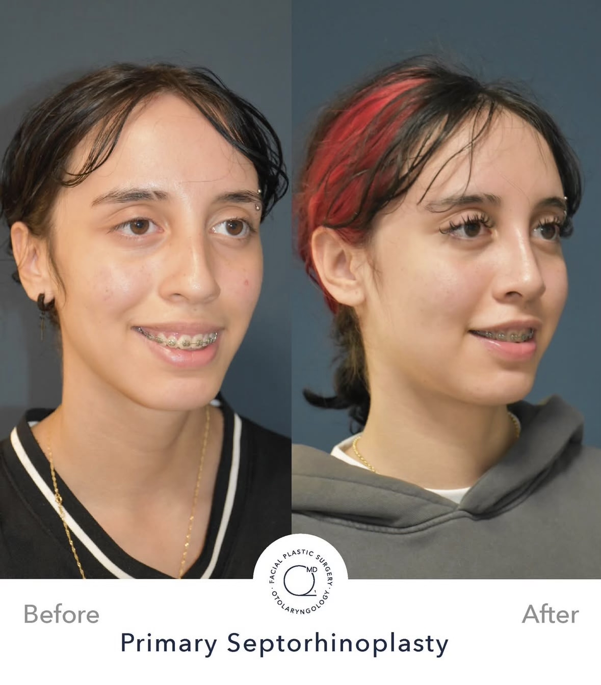 Rinoplastia femenina — fotografía interna oblicua