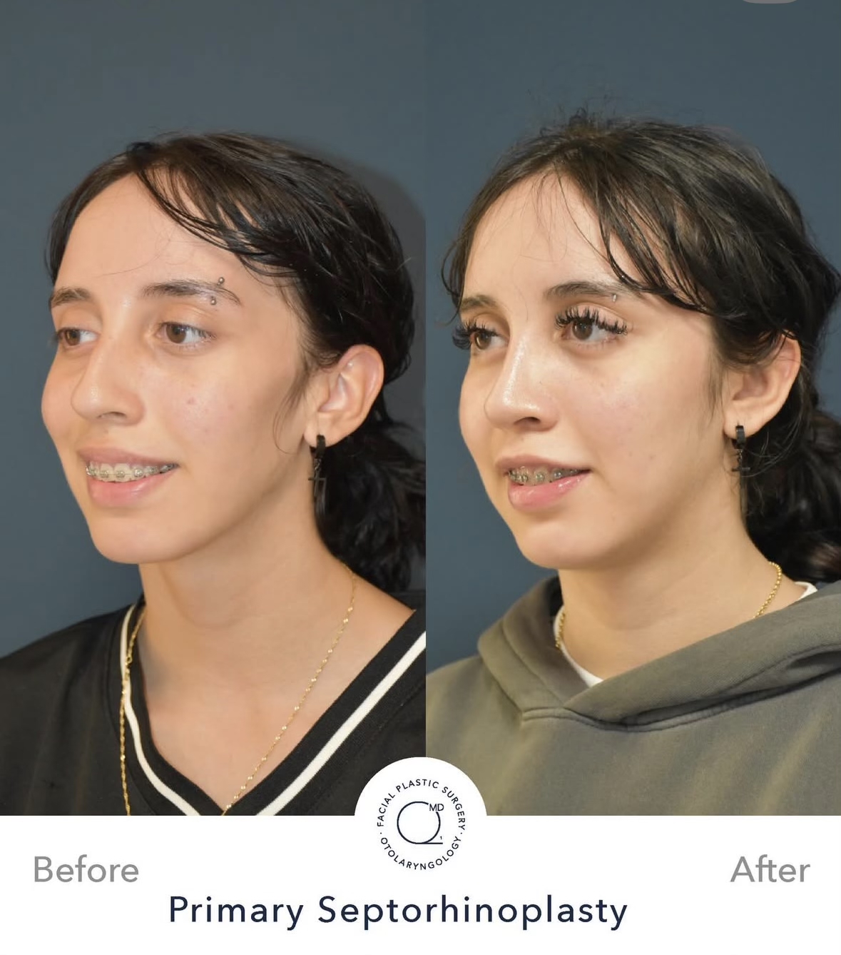 Rinoplastia femenina — fotografía interna oblicua