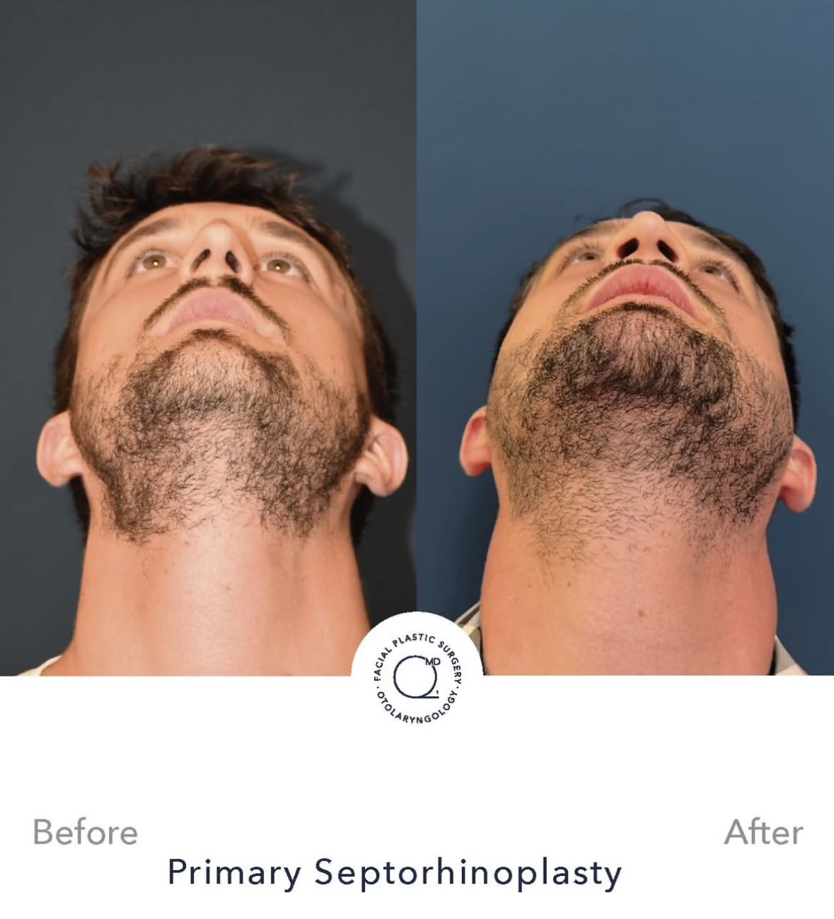 Rinoplastia masculina — fotografía interna inferior