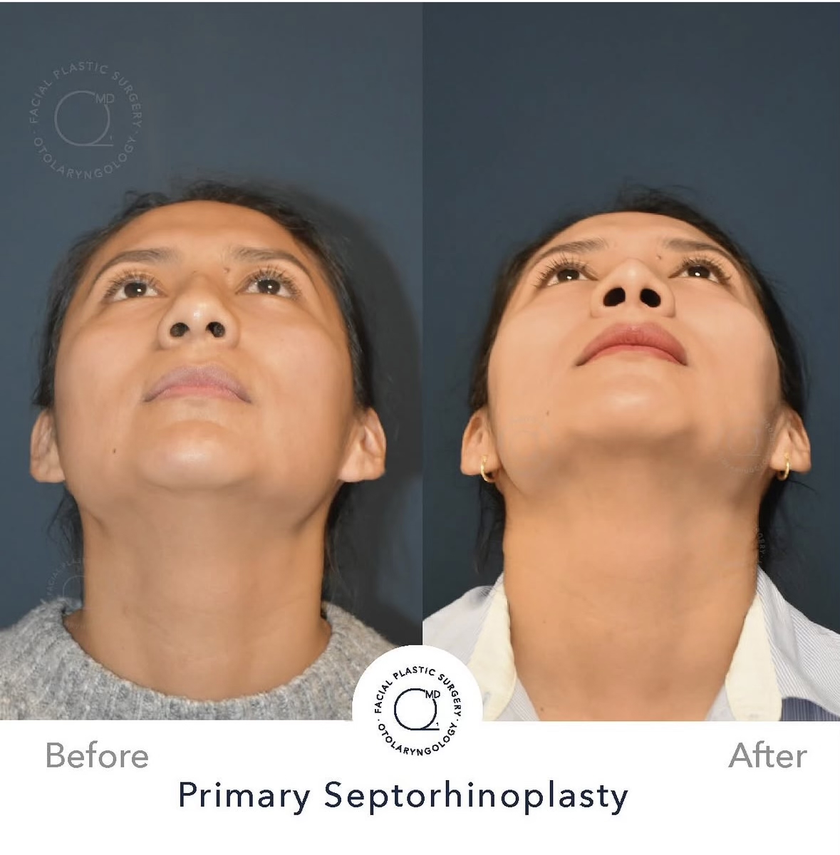 Rinoplastia femenina — fotografía interna inferior
