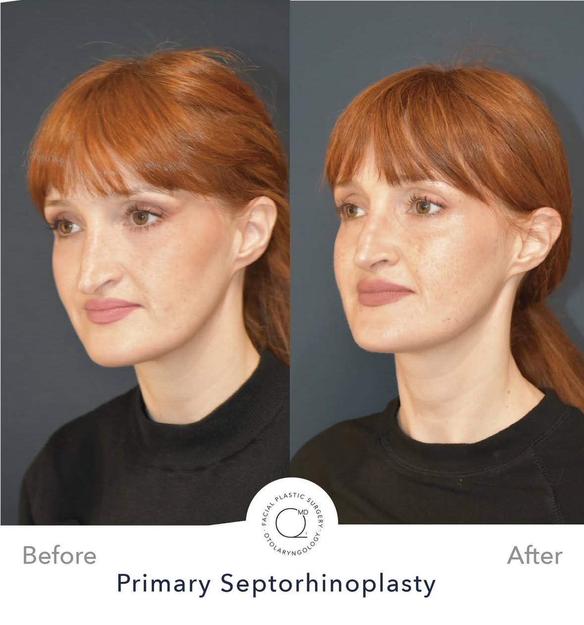 Rinoplastia femenina — fotografía interna oblicua
