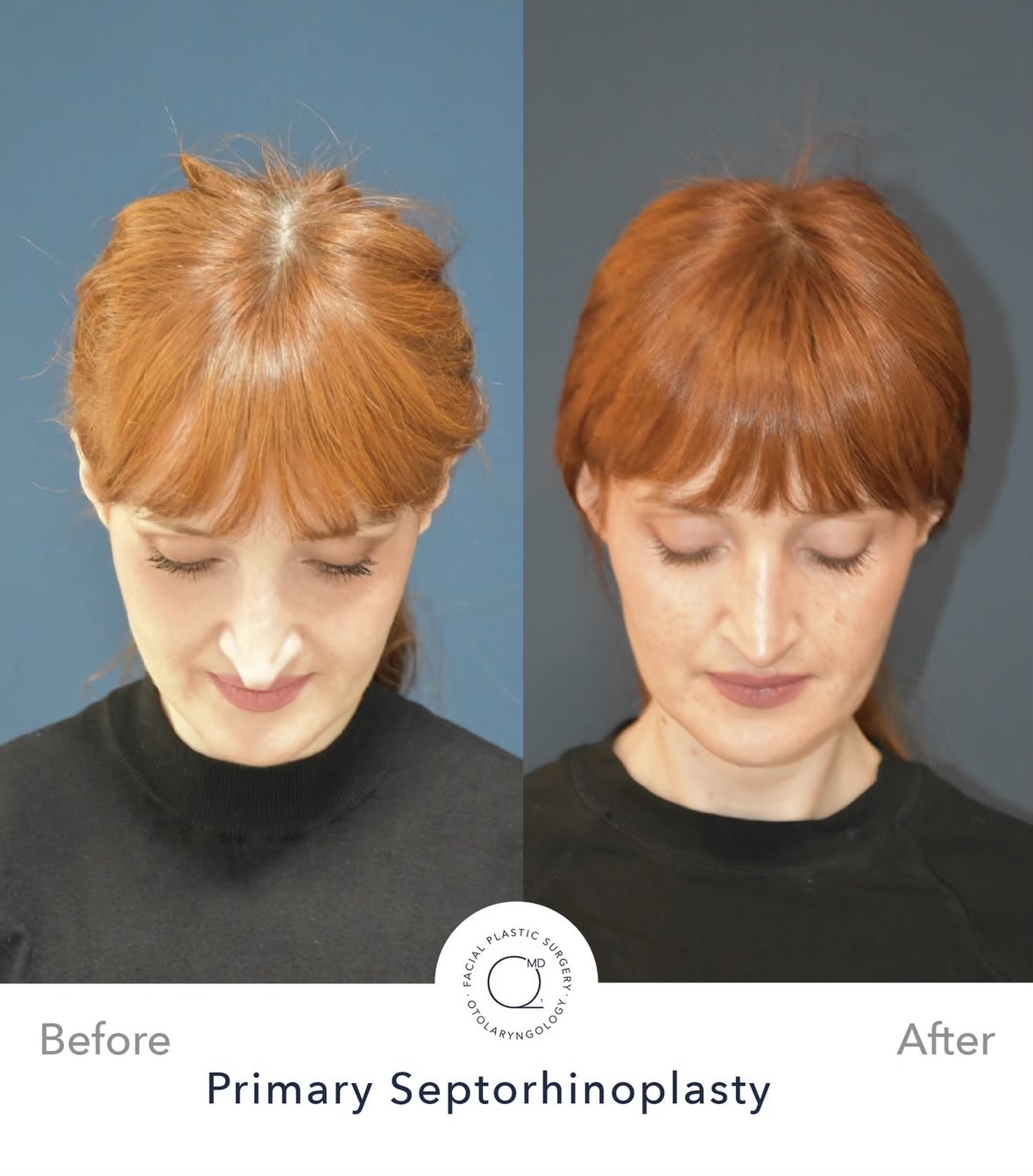 Rinoplastia femenina — fotografía interna superior