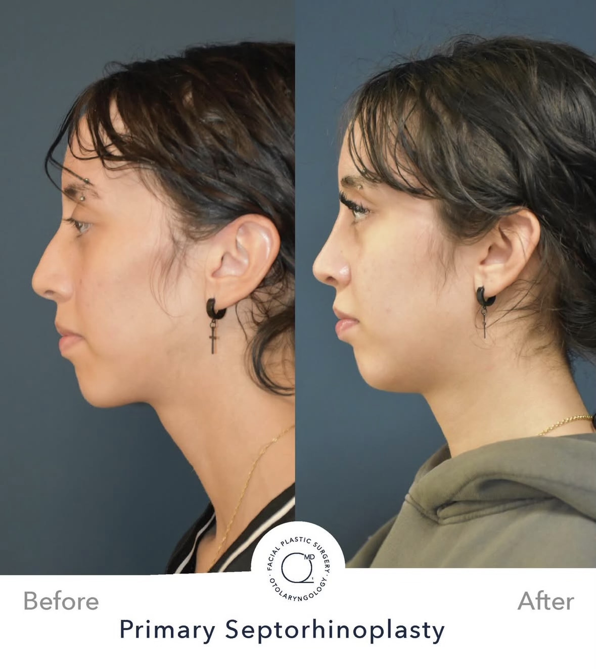 Rinoplastia femenina — fotografía interna lateral