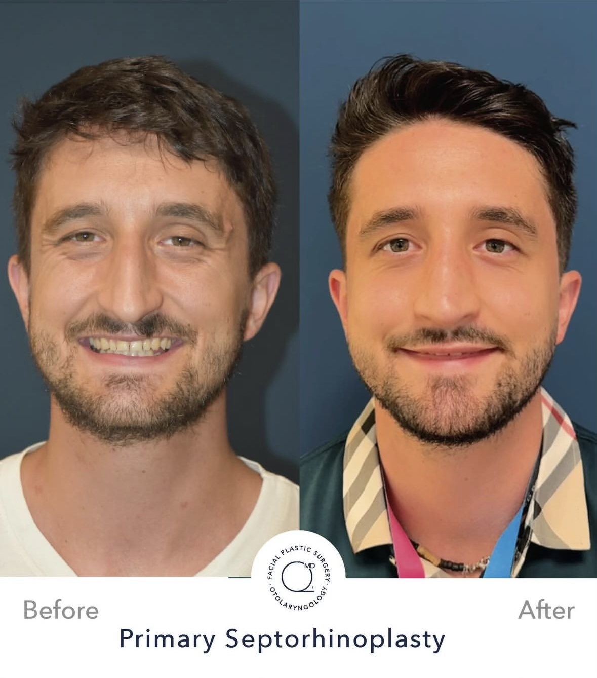 Rinoplastia masculina — fotografía interna frontal