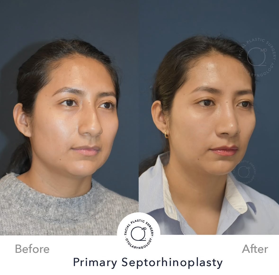 Rinoplastia femenina — fotografía interna frontal oblicua