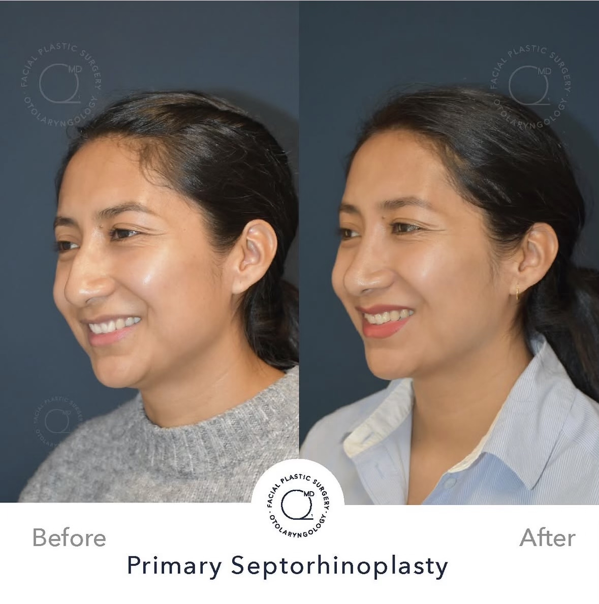 Rinoplastia femenina — fotografía interna oblicua sonriente