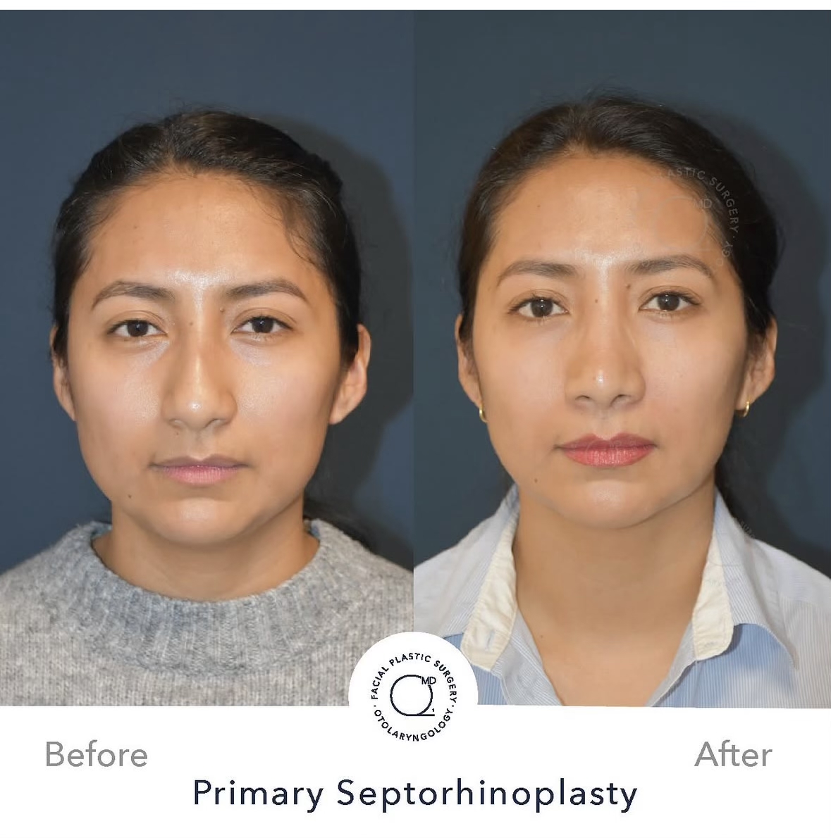 Rinoplastia femenina — fotografía interna frontal