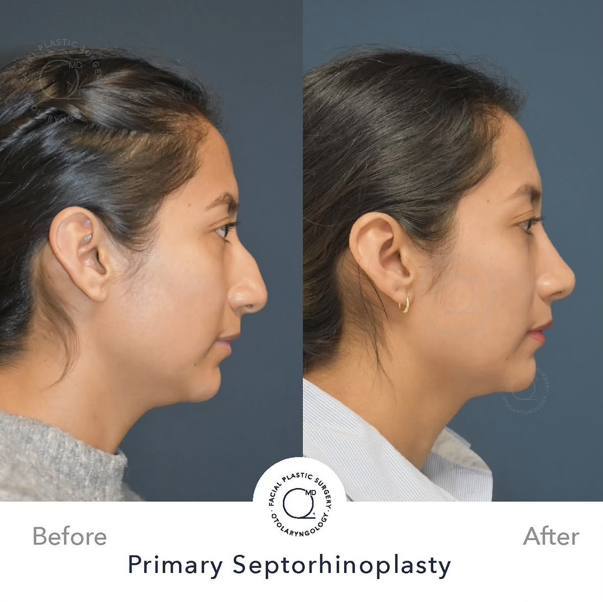 Rinoplastia femenina — fotografía interna lateral