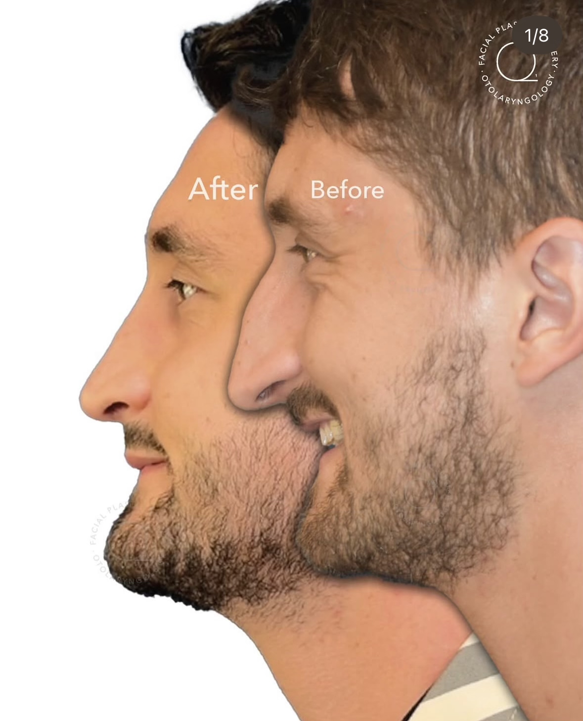 Rinoplastia masculina antes y después