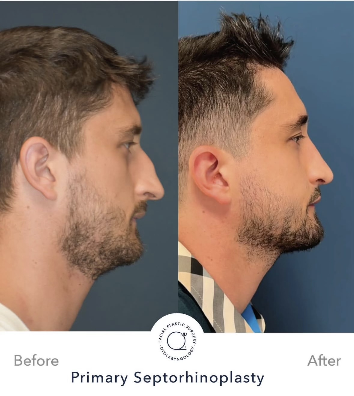 Rinoplastia masculina — fotografía interna lateral