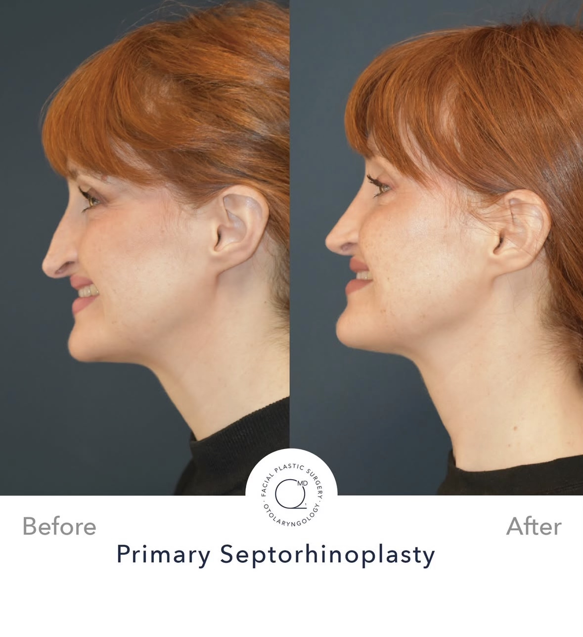 Rinoplastia femenina — fotografía interna lateral