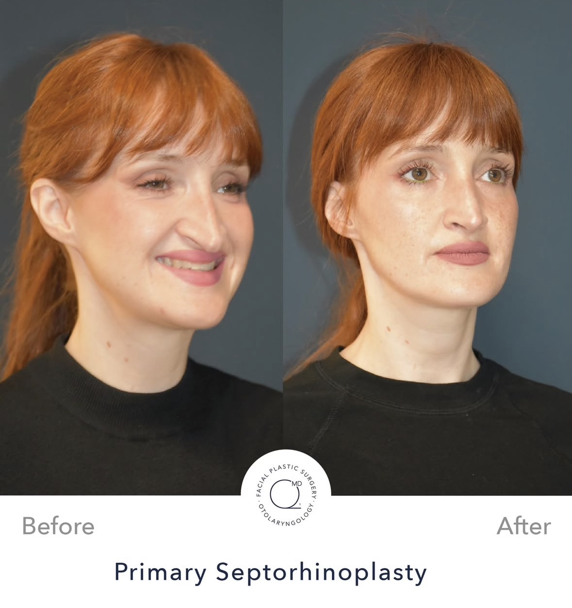 Rinoplastia femenina — fotografía interna oblicua