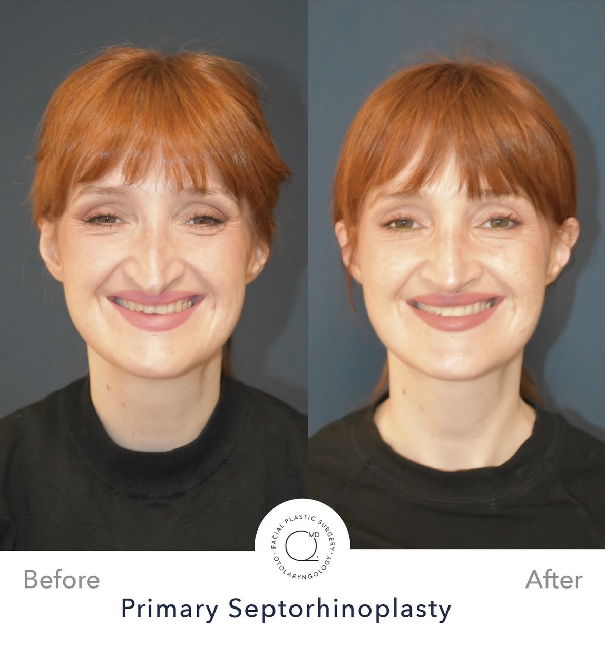 Rinoplastia femenina — fotografía interna frontal
