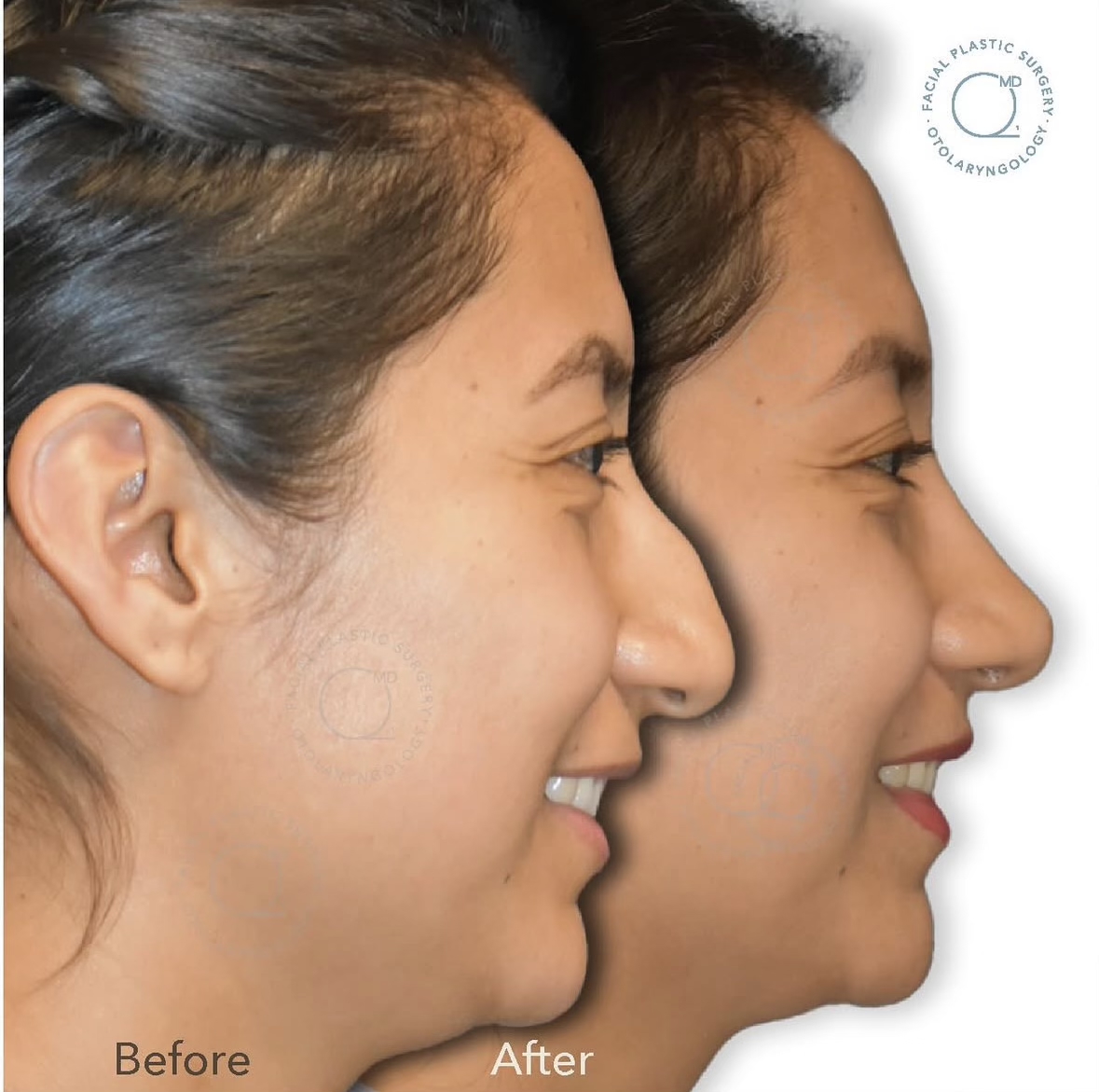 Rinoplastia femenina — fotografía interna lateral