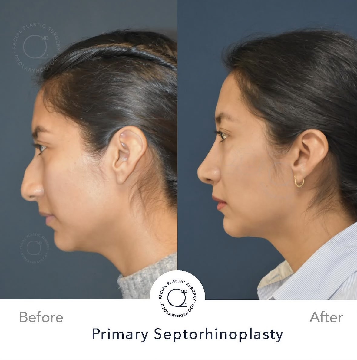 Rinoplastia femenina — fotografía interna lateral