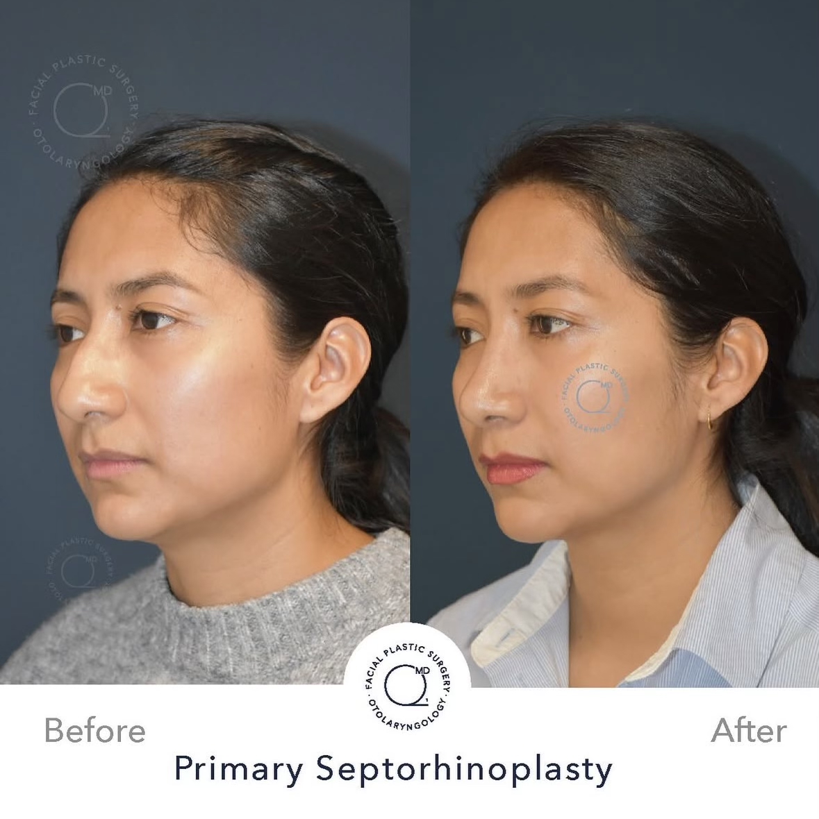 Rinoplastia femenina — fotografía interna oblicua