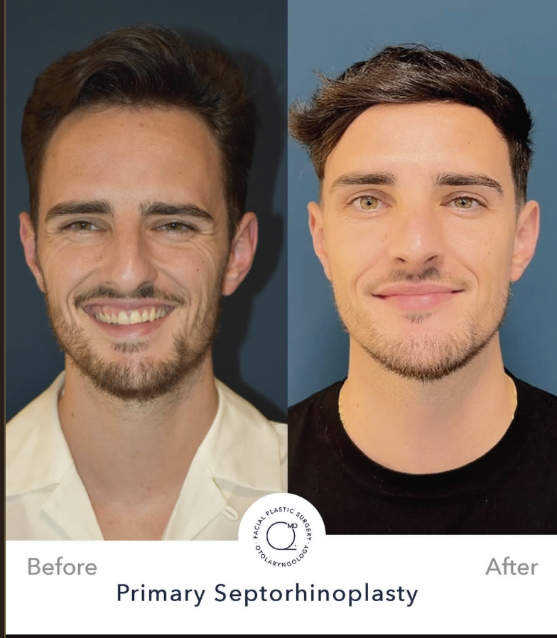 Rinoplastia masculina antes y después — portada