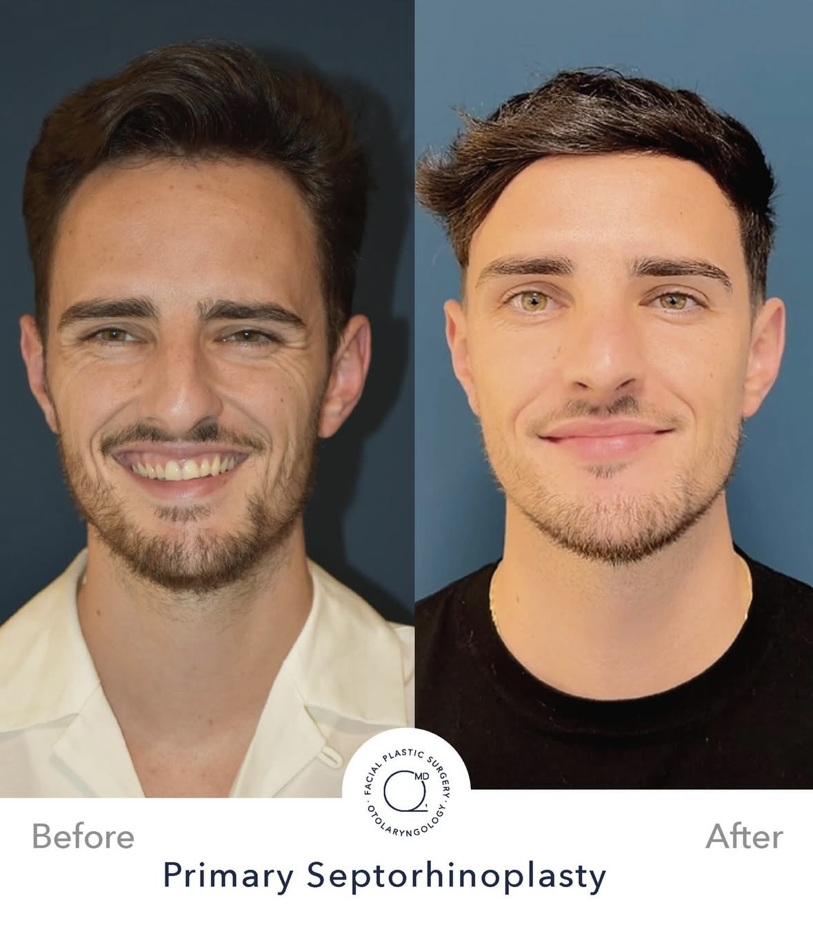 Rinoplastia masculina antes y después — fotografía 1