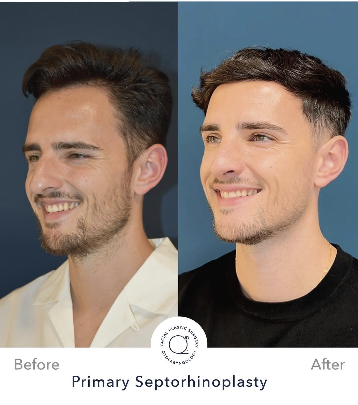 Rinoplastia masculina antes y después — fotografía 2
