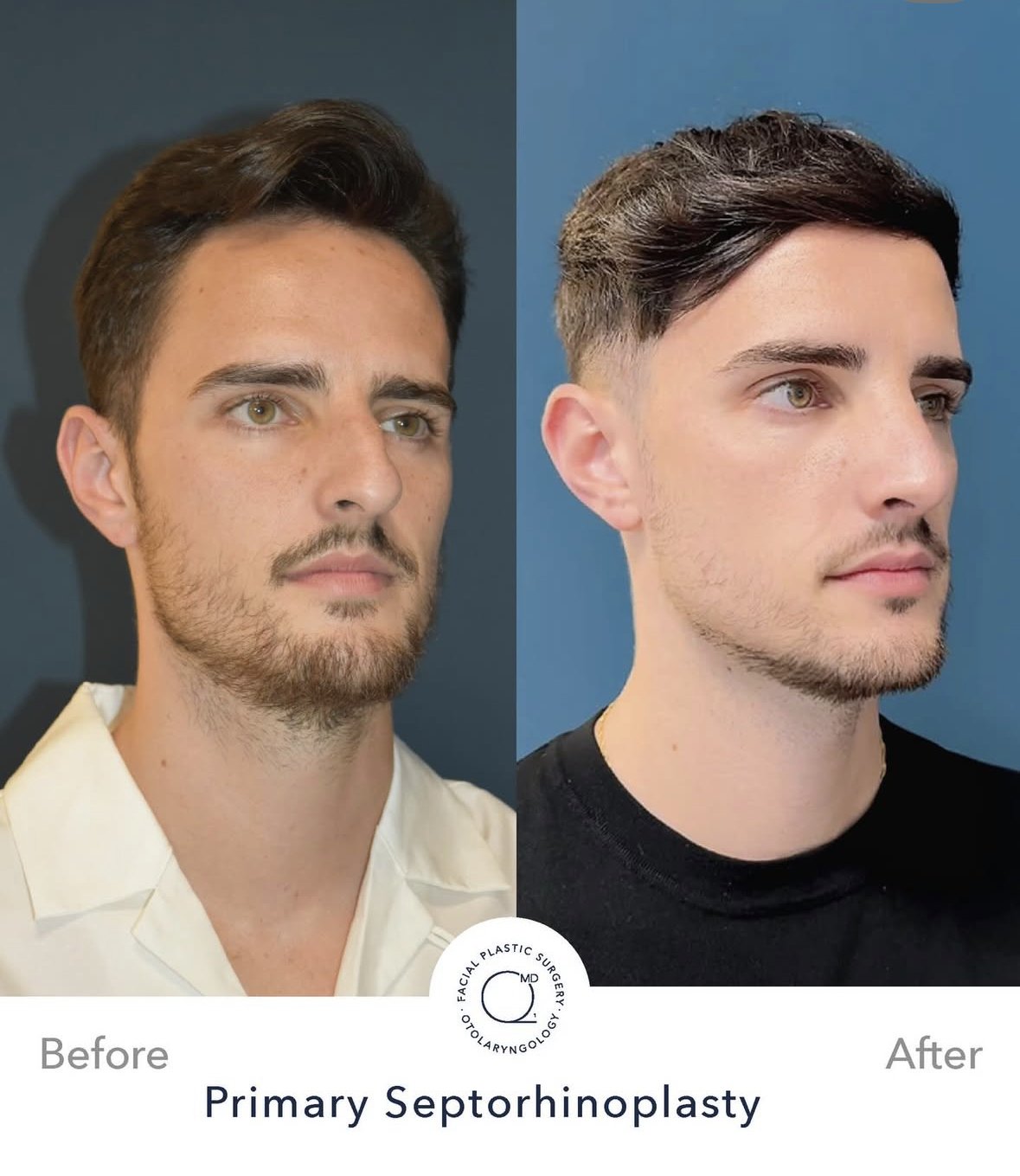 Rinoplastia masculina antes y después — fotografía 3