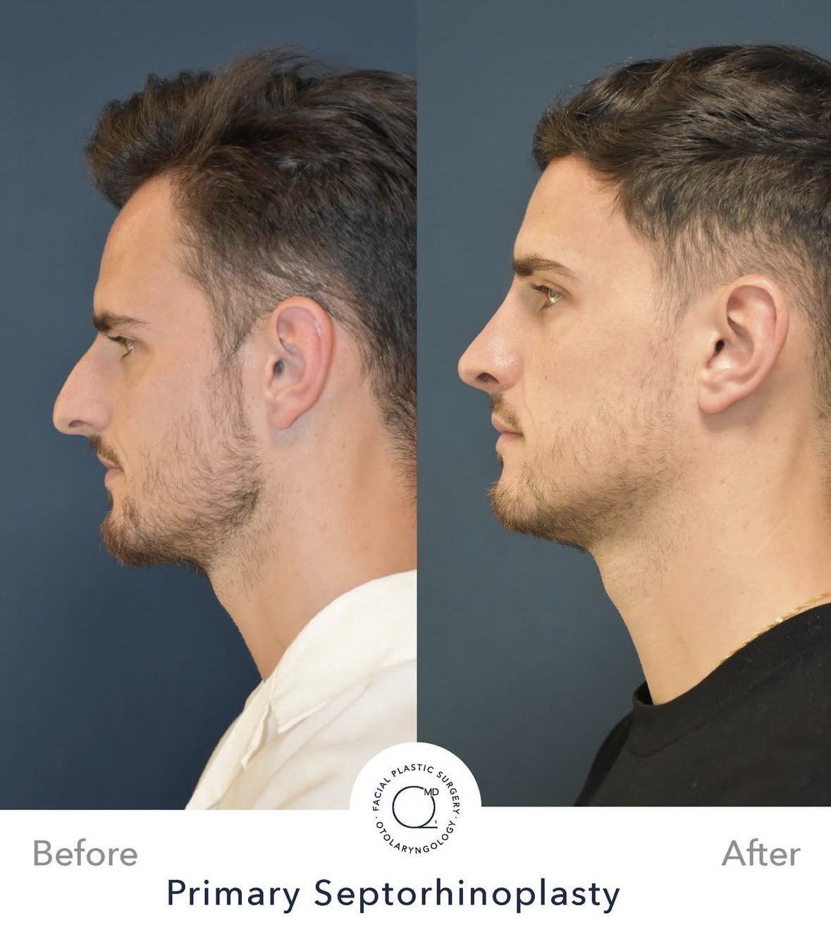 Rinoplastia masculina antes y después — fotografía 4